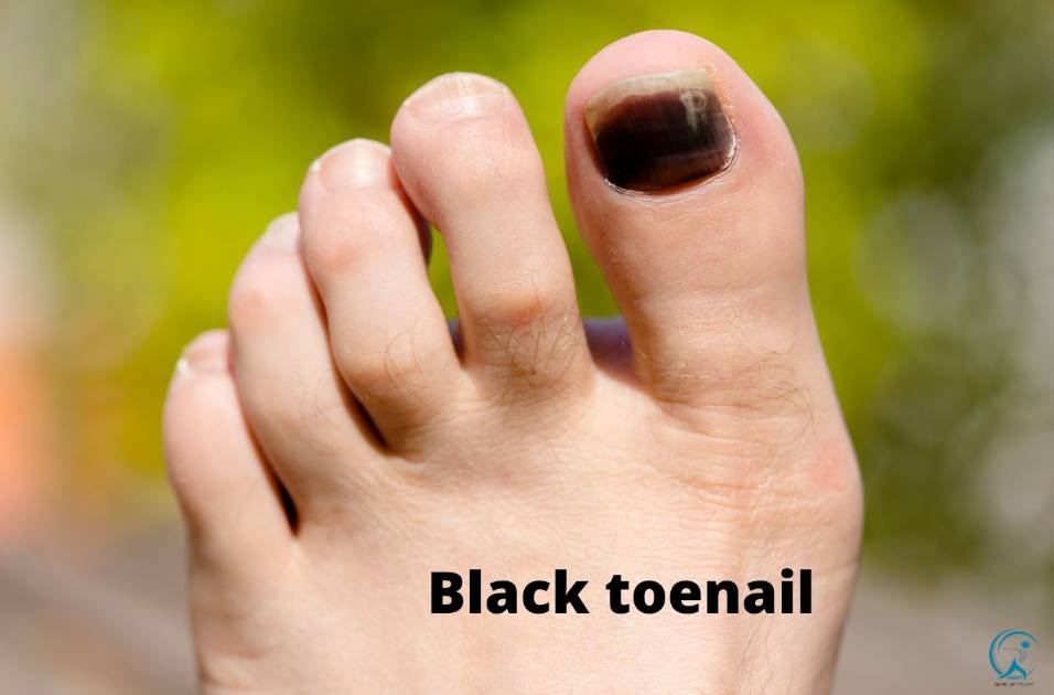 Black toenail