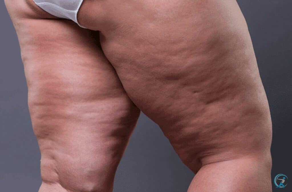 Lipoedema is a condition in which your body retains fat in your legs, arms, and buttocks. 