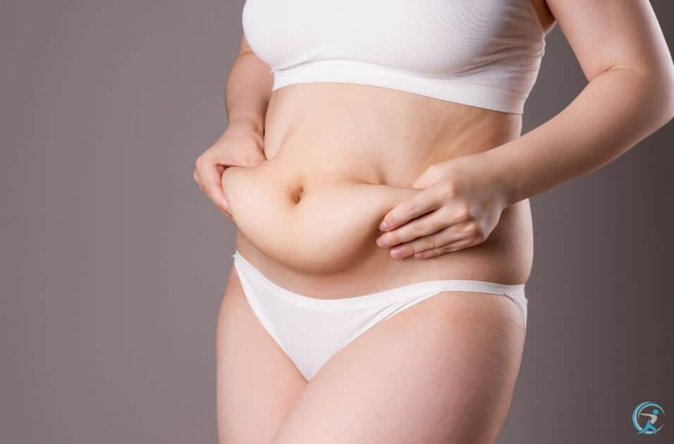  best candidates for a tummy tuck 