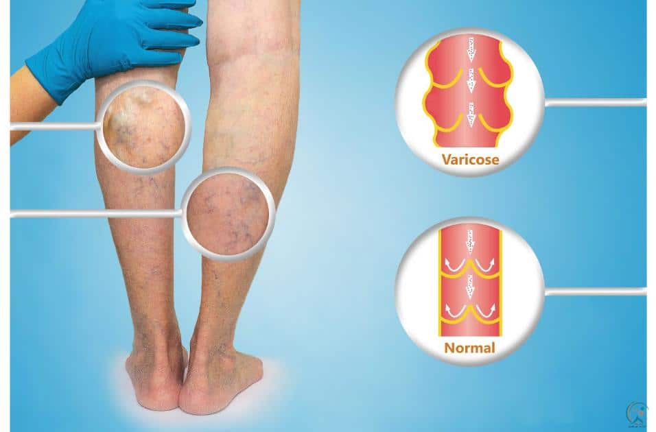 Causes of Varicose Veins and Spider Veins