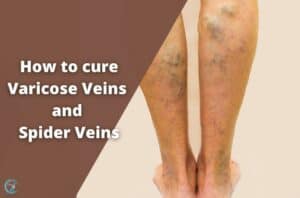 How can we cure Varicose Veins and Spider Veins permanently