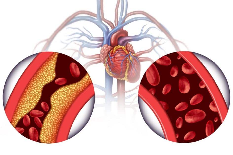 Arterial hypertension