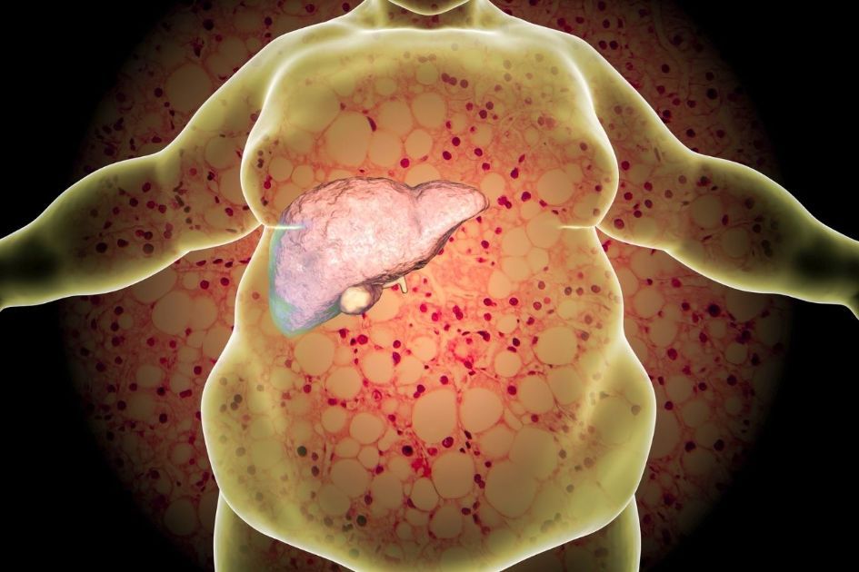 Metabolic disorders: Insulin resistance and type 2 diabetes, and fatty liver