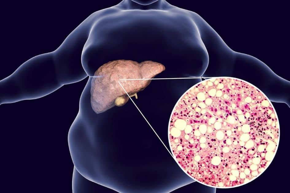 Metabolic Syndrome