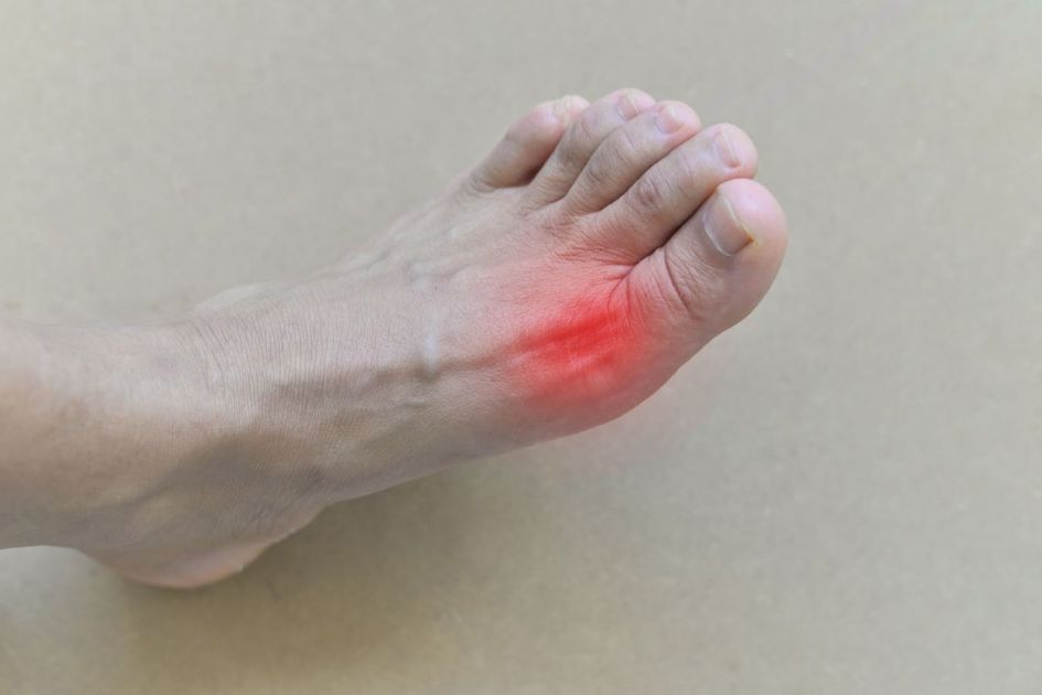 How to Use CBD Oil for Joint Pain caused by Gout