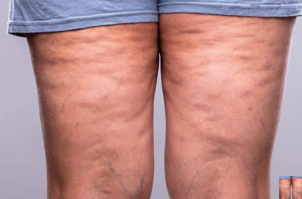 Lipoedema is a chronic condition that causes an abnormal build-up of fat cells in the body, most commonly in the legs, thighs, and buttocks. It can also affect the arms.