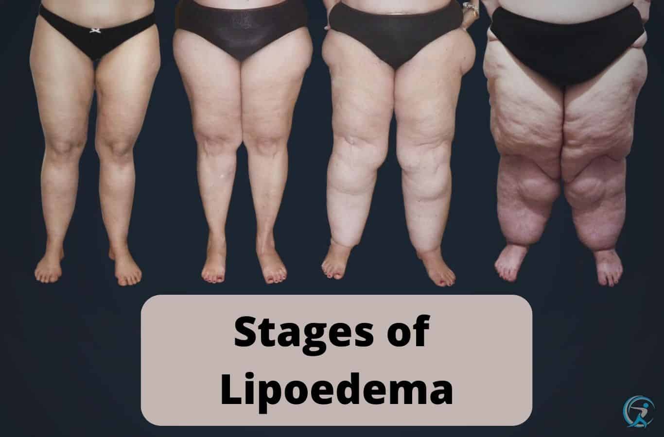 Treating Lipoedema and Getting Rid Of Excess Fat