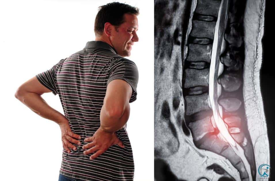 If your spine has an abnormal curve that puts pressure on a nerve root, you may have lower back pain, numbness, tingling, or weakness in your legs or arms. 