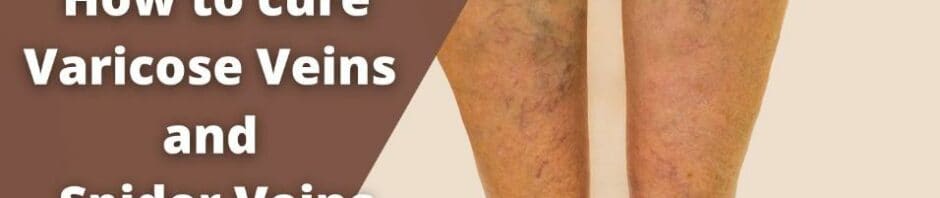 How can we cure Varicose Veins and Spider Veins permanently