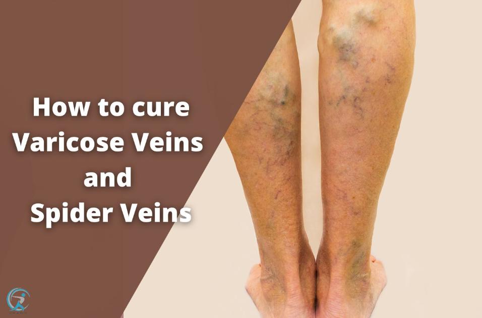 How Can we Cure Varicose Veins and Spider Veins Permanently?