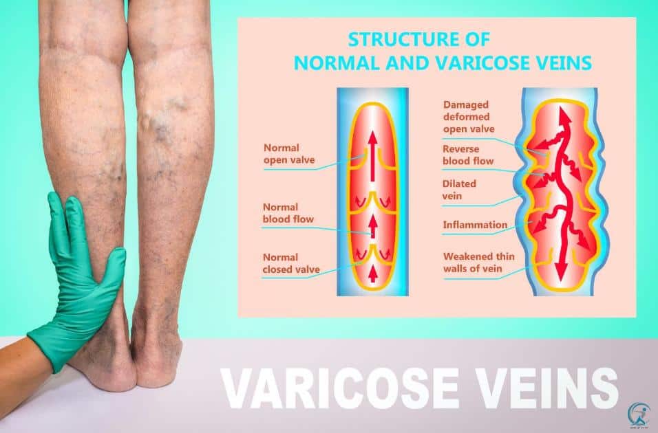 What is the structure of normal and varicose veins?